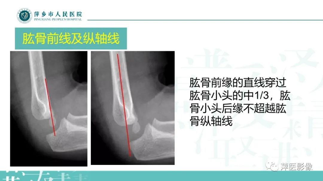 影像PPT - 【PPT】儿童肘关节损伤X线表现-8