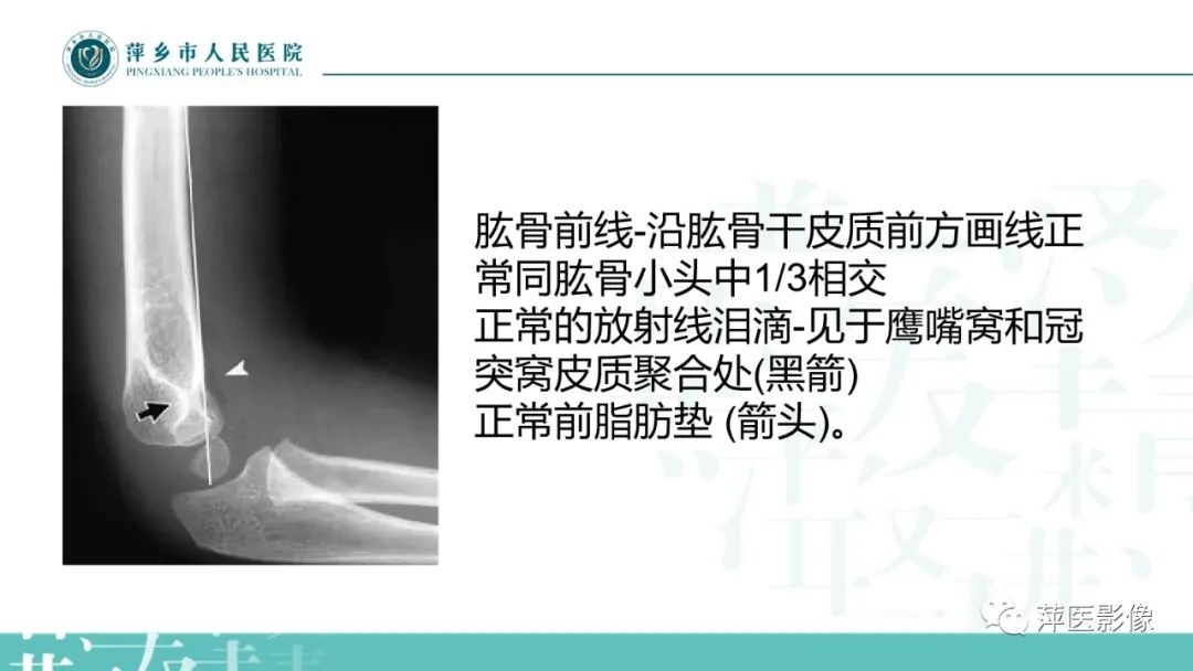 影像PPT - 【PPT】儿童肘关节损伤X线表现-9