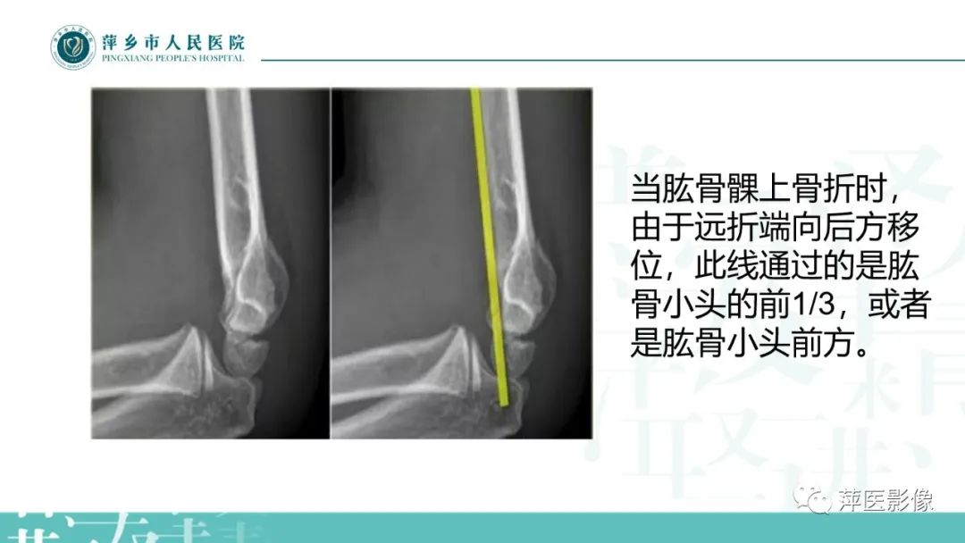 影像PPT - 【PPT】儿童肘关节损伤X线表现-10