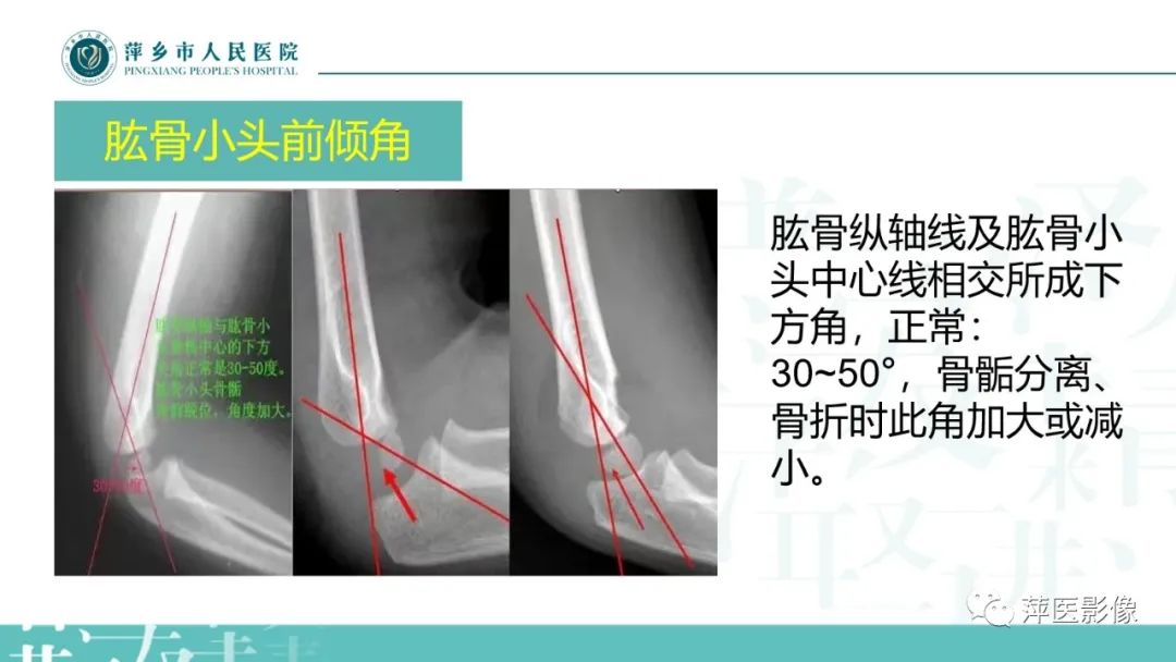 影像PPT - 【PPT】儿童肘关节损伤X线表现-11