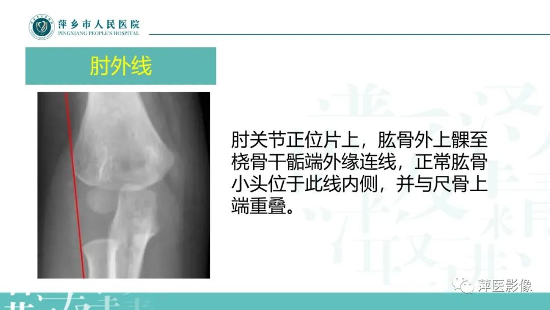 影像PPT - 【PPT】儿童肘关节损伤X线表现-12