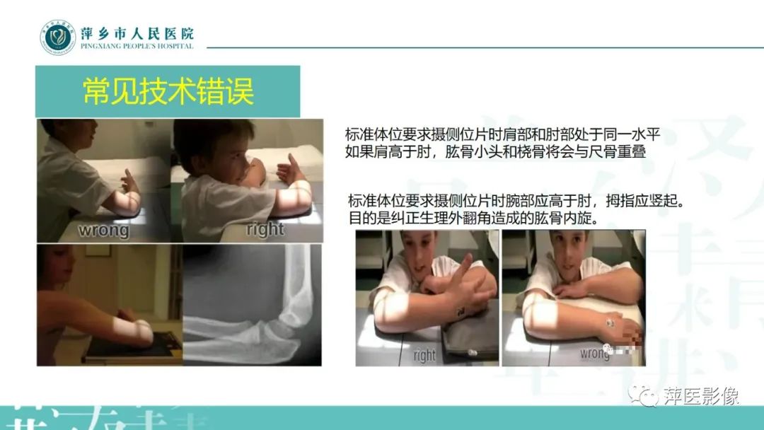 影像PPT - 【PPT】儿童肘关节损伤X线表现-14
