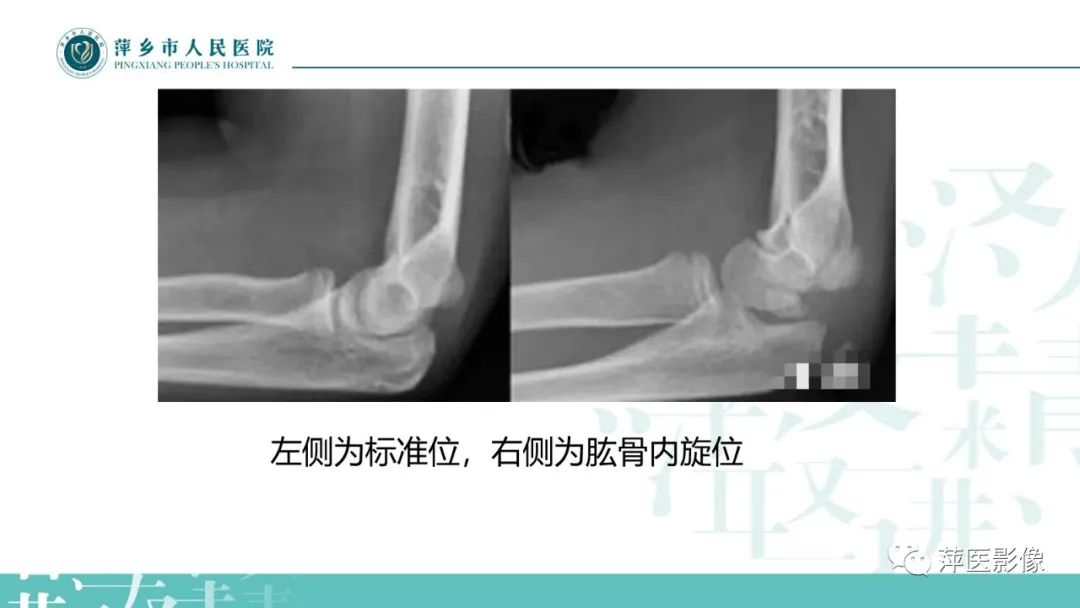 影像PPT - 【PPT】儿童肘关节损伤X线表现-15