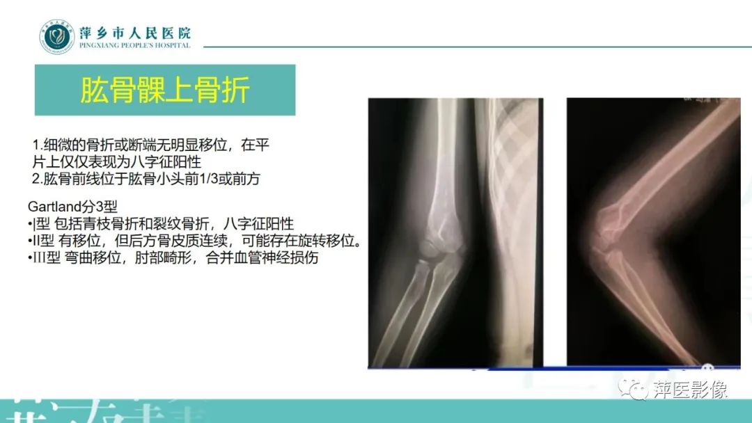 影像PPT - 【PPT】儿童肘关节损伤X线表现-18
