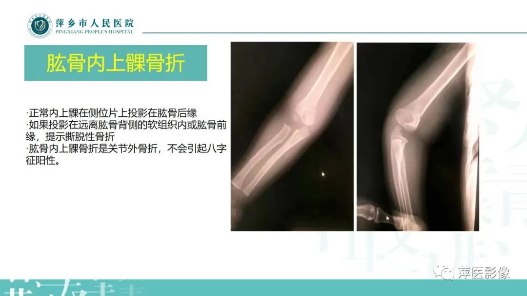 影像PPT - 【PPT】儿童肘关节损伤X线表现-21