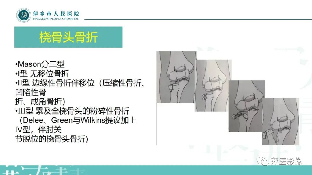 影像PPT - 【PPT】儿童肘关节损伤X线表现-22