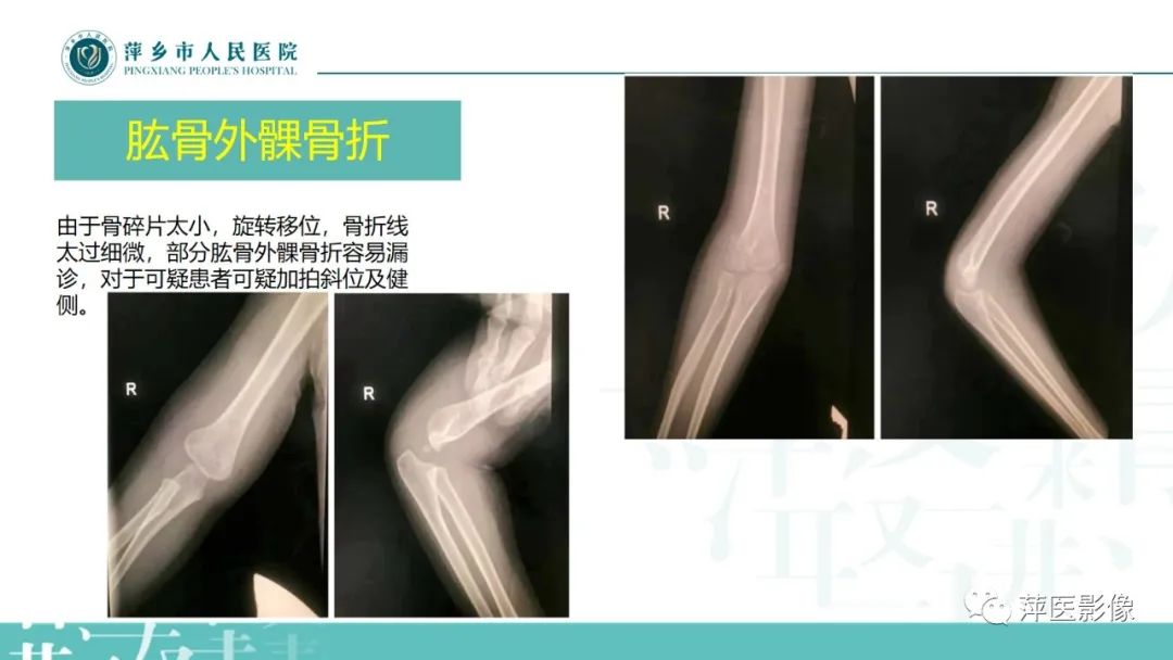影像PPT - 【PPT】儿童肘关节损伤X线表现-20