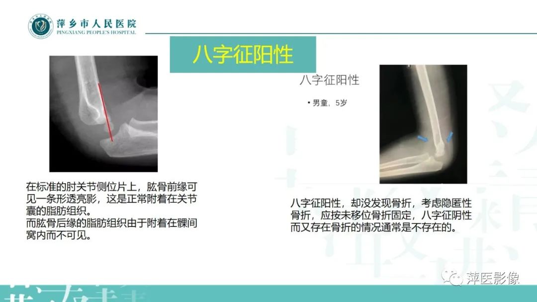 影像PPT - 【PPT】儿童肘关节损伤X线表现-19