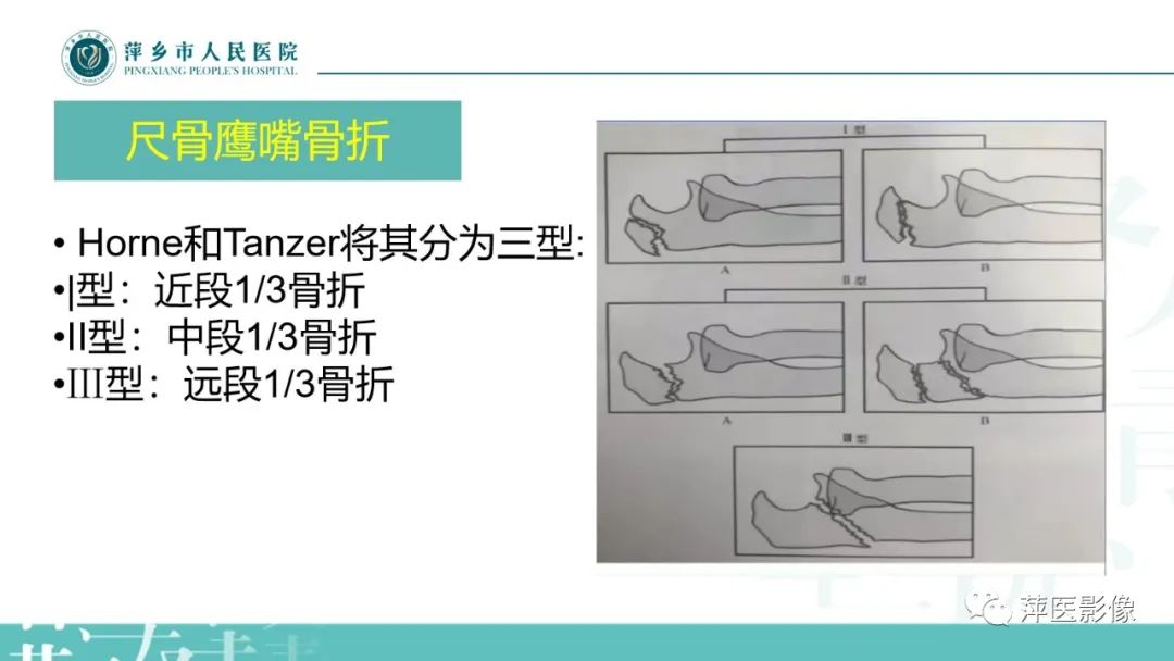 影像PPT - 【PPT】儿童肘关节损伤X线表现-24
