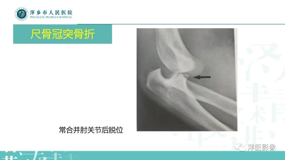 影像PPT - 【PPT】儿童肘关节损伤X线表现-26