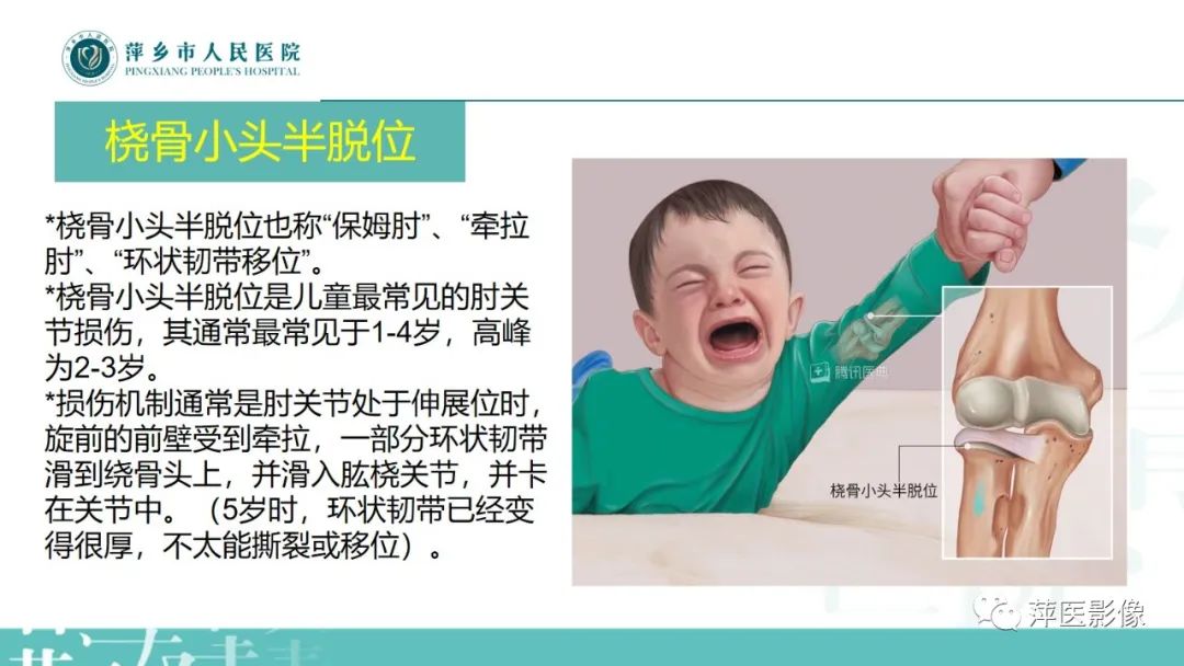 影像PPT - 【PPT】儿童肘关节损伤X线表现-27