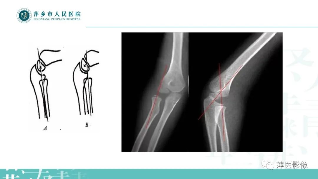影像PPT - 【PPT】儿童肘关节损伤X线表现-28