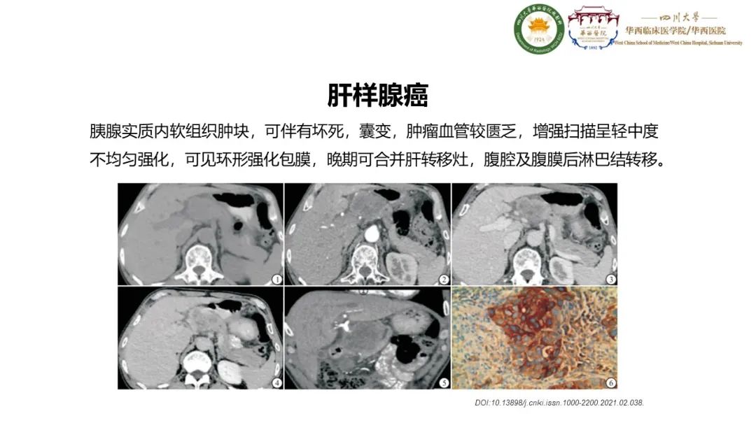 影像PPT - 【病例】胰腺肝样腺癌1例CT影像-8