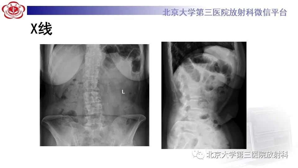 影像PPT - 【PPT】布鲁氏菌性脊柱炎-3