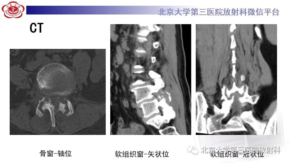 影像PPT - 【PPT】布鲁氏菌性脊柱炎-4