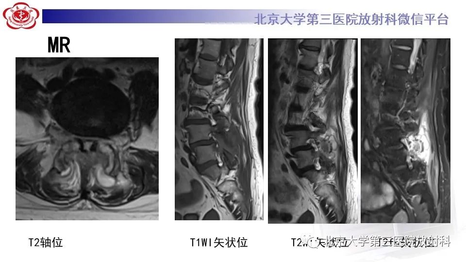影像PPT - 【PPT】布鲁氏菌性脊柱炎-5