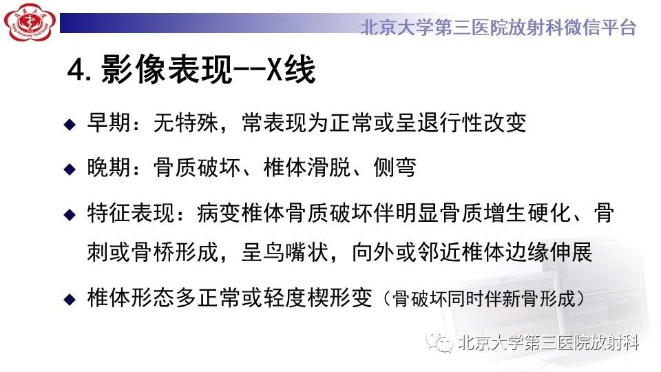影像PPT - 【PPT】布鲁氏菌性脊柱炎-16