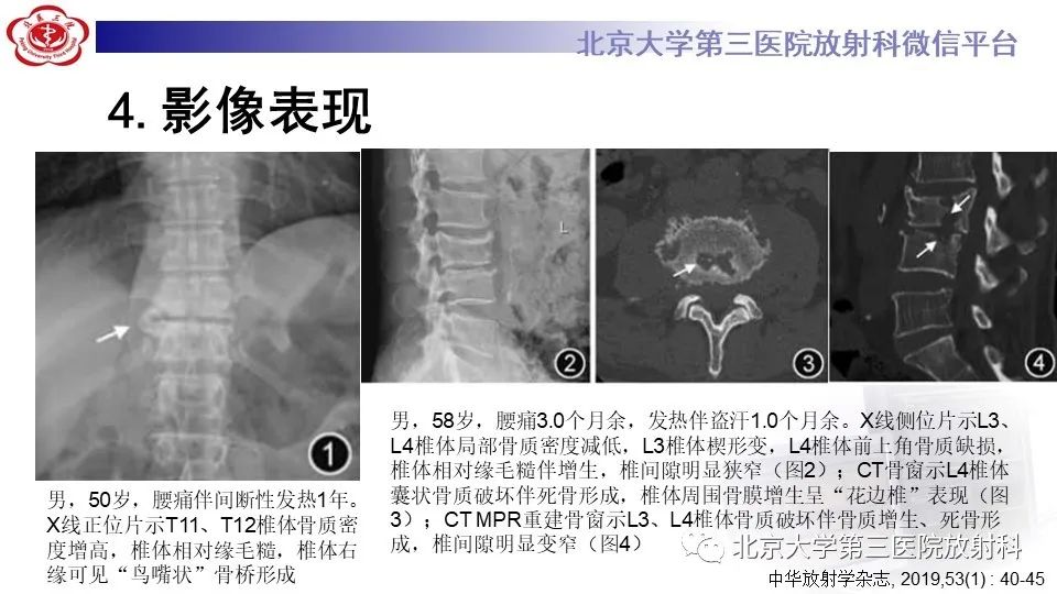 影像PPT - 【PPT】布鲁氏菌性脊柱炎-19