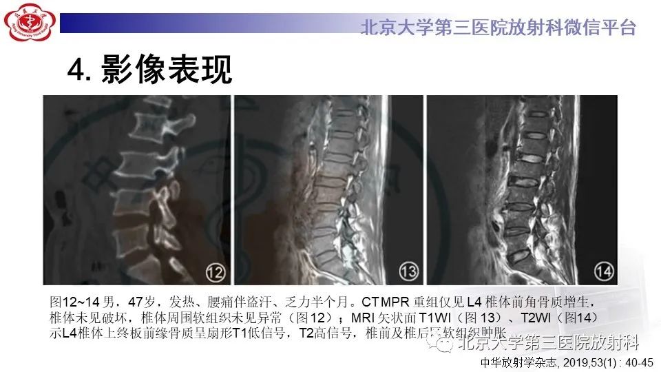 影像PPT - 【PPT】布鲁氏菌性脊柱炎-21
