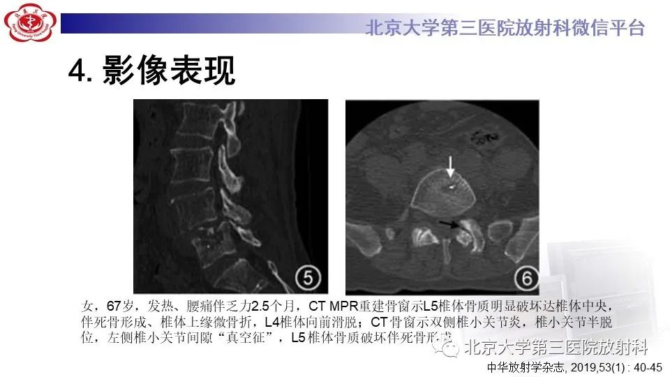 影像PPT - 【PPT】布鲁氏菌性脊柱炎-20