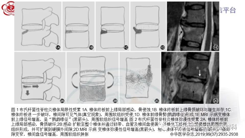 影像PPT - 【PPT】布鲁氏菌性脊柱炎-22