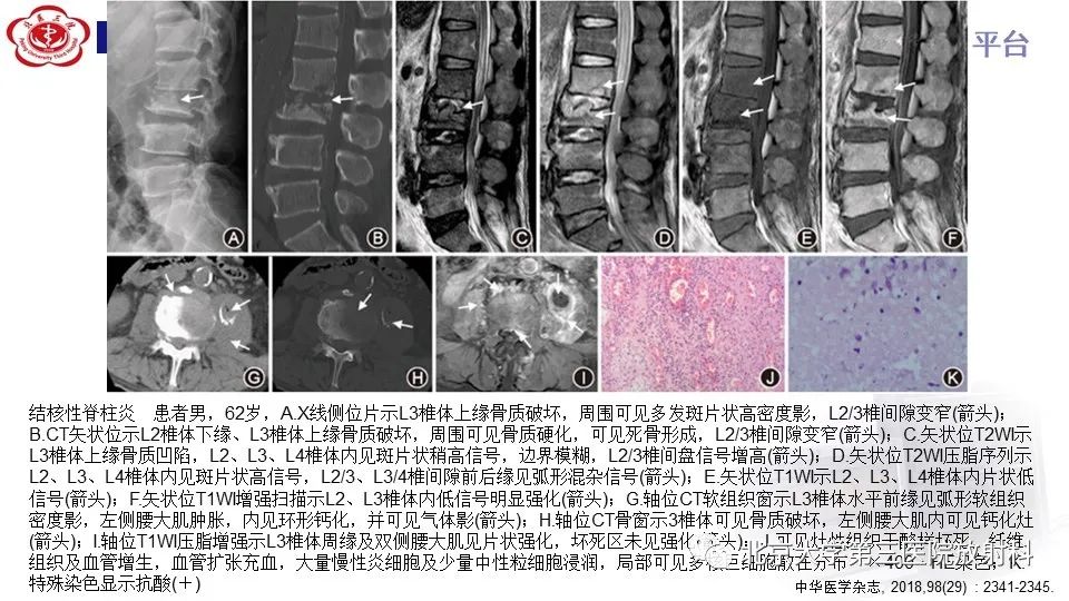 影像PPT - 【PPT】布鲁氏菌性脊柱炎-26