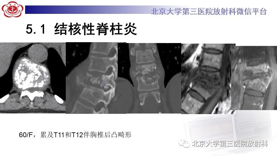 影像PPT - 【PPT】布鲁氏菌性脊柱炎-27