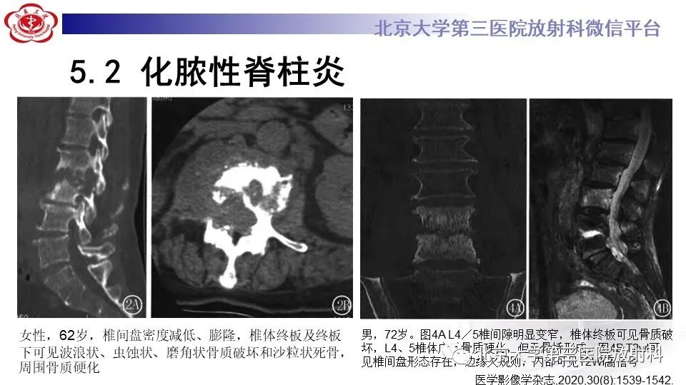 影像PPT - 【PPT】布鲁氏菌性脊柱炎-29