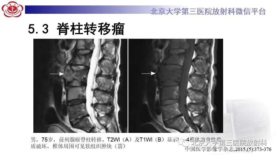 影像PPT - 【PPT】布鲁氏菌性脊柱炎-32