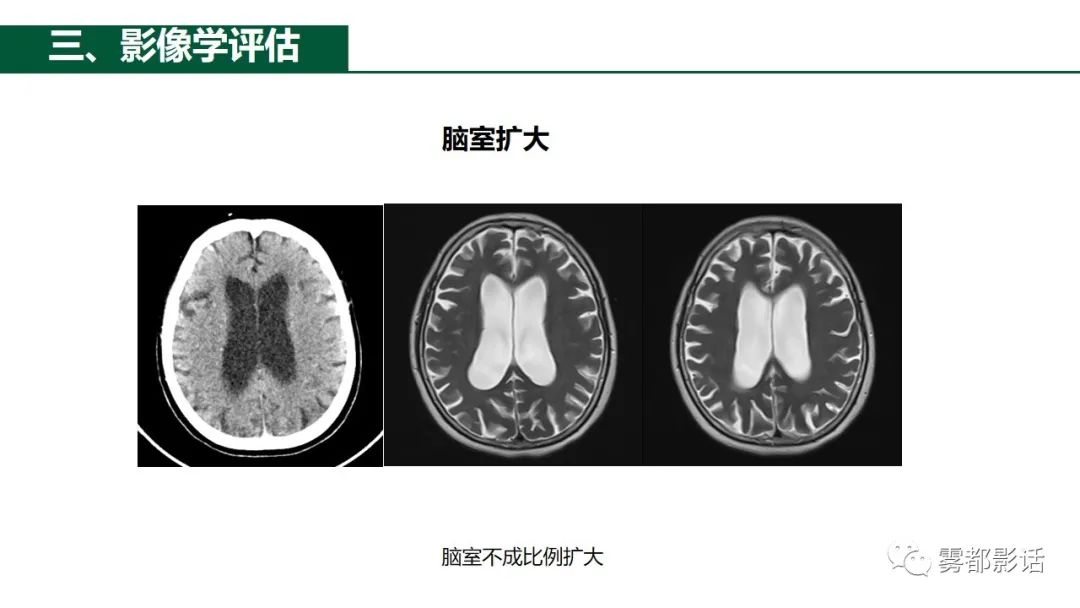 影像PPT - 【PPT】特发性正常压力脑积水的影像诊断-10