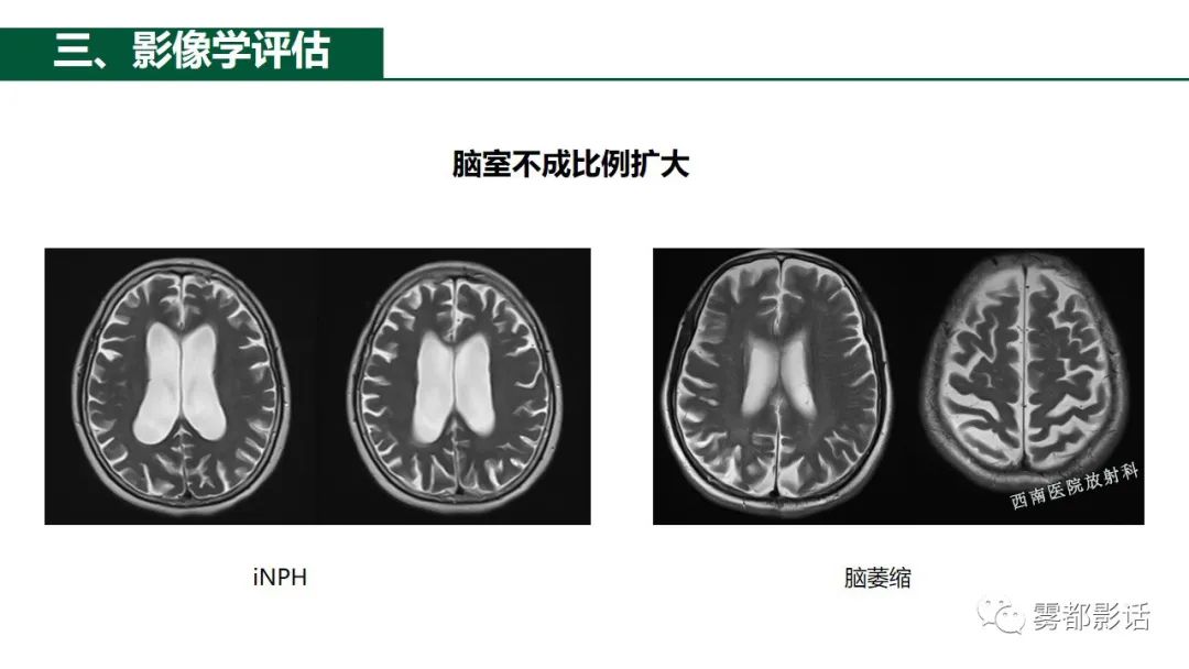 影像PPT - 【PPT】特发性正常压力脑积水的影像诊断-11
