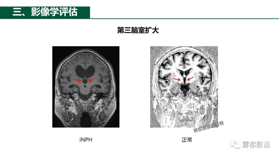 影像PPT - 【PPT】特发性正常压力脑积水的影像诊断-12