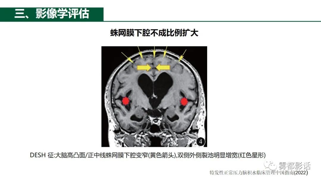 影像PPT - 【PPT】特发性正常压力脑积水的影像诊断-13
