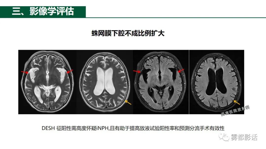 影像PPT - 【PPT】特发性正常压力脑积水的影像诊断-14