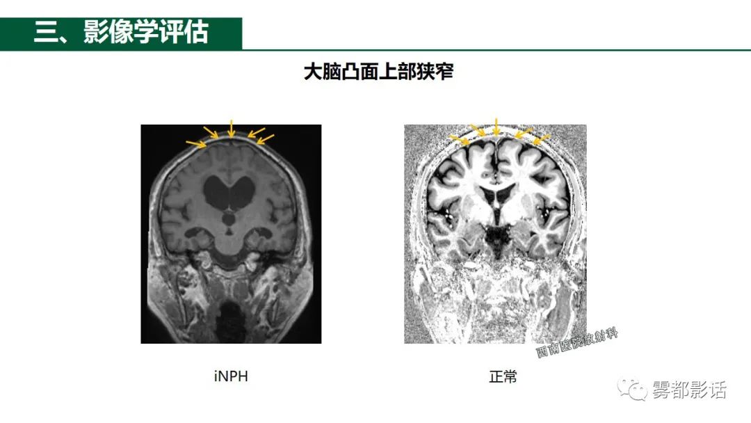 影像PPT - 【PPT】特发性正常压力脑积水的影像诊断-15