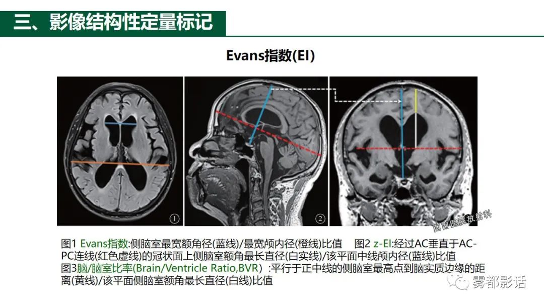 影像PPT - 【PPT】特发性正常压力脑积水的影像诊断-16