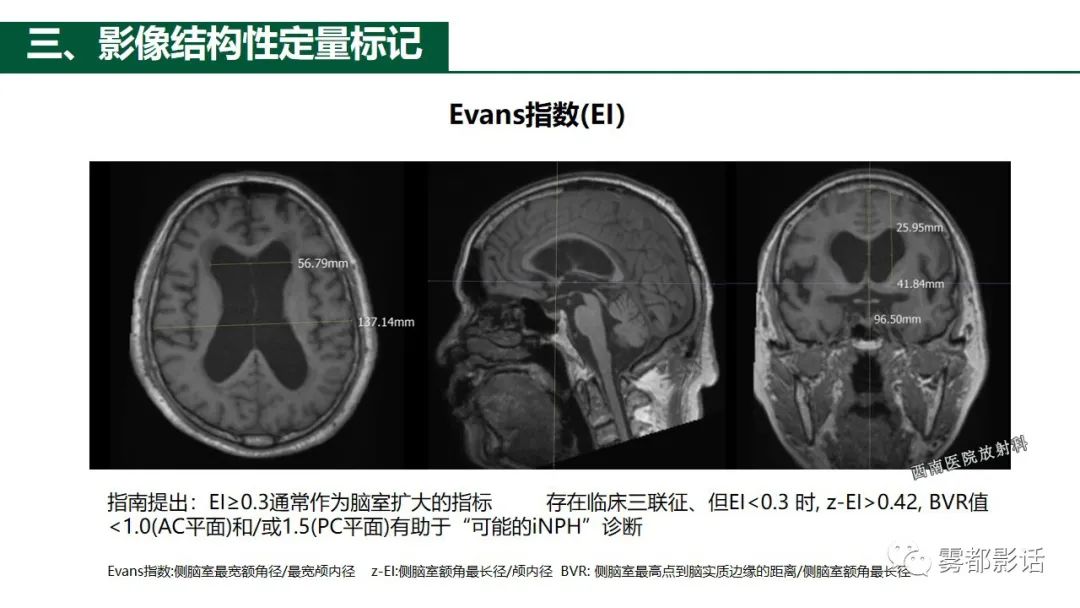 影像PPT - 【PPT】特发性正常压力脑积水的影像诊断-17