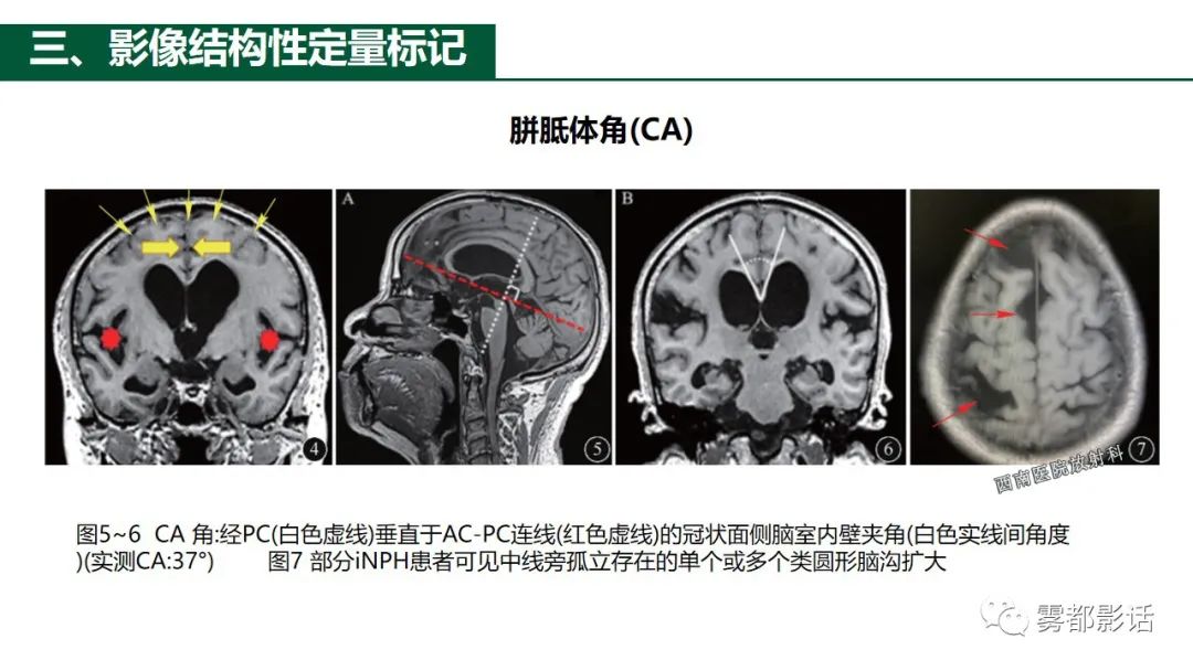 影像PPT - 【PPT】特发性正常压力脑积水的影像诊断-18