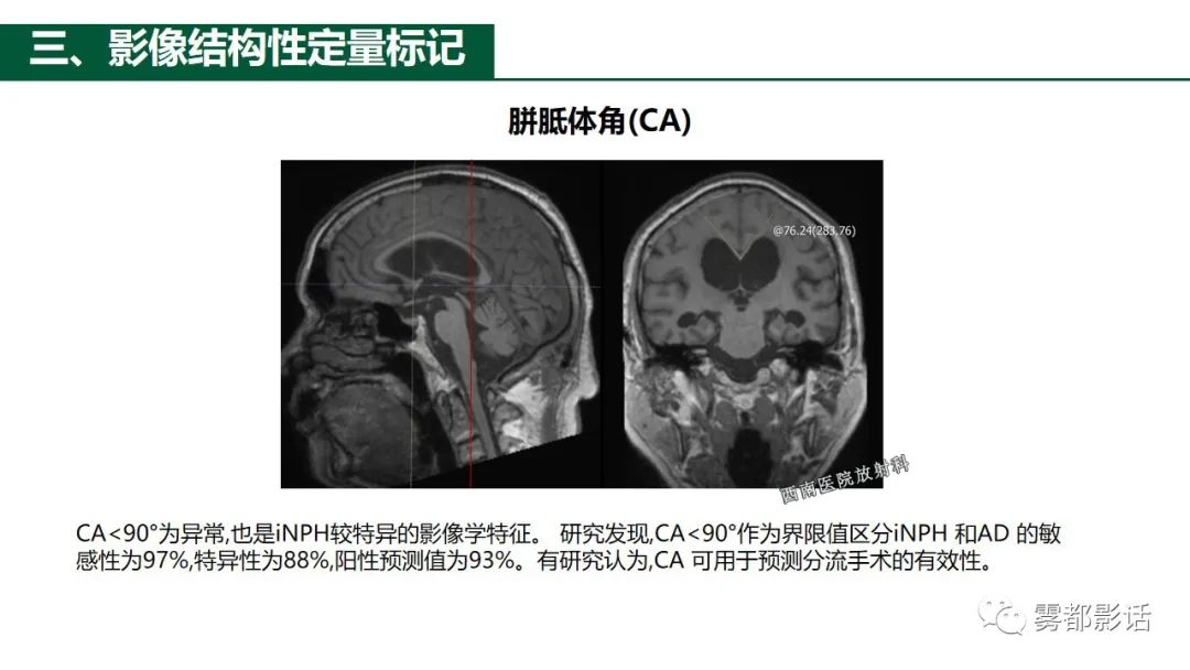 影像PPT - 【PPT】特发性正常压力脑积水的影像诊断-19