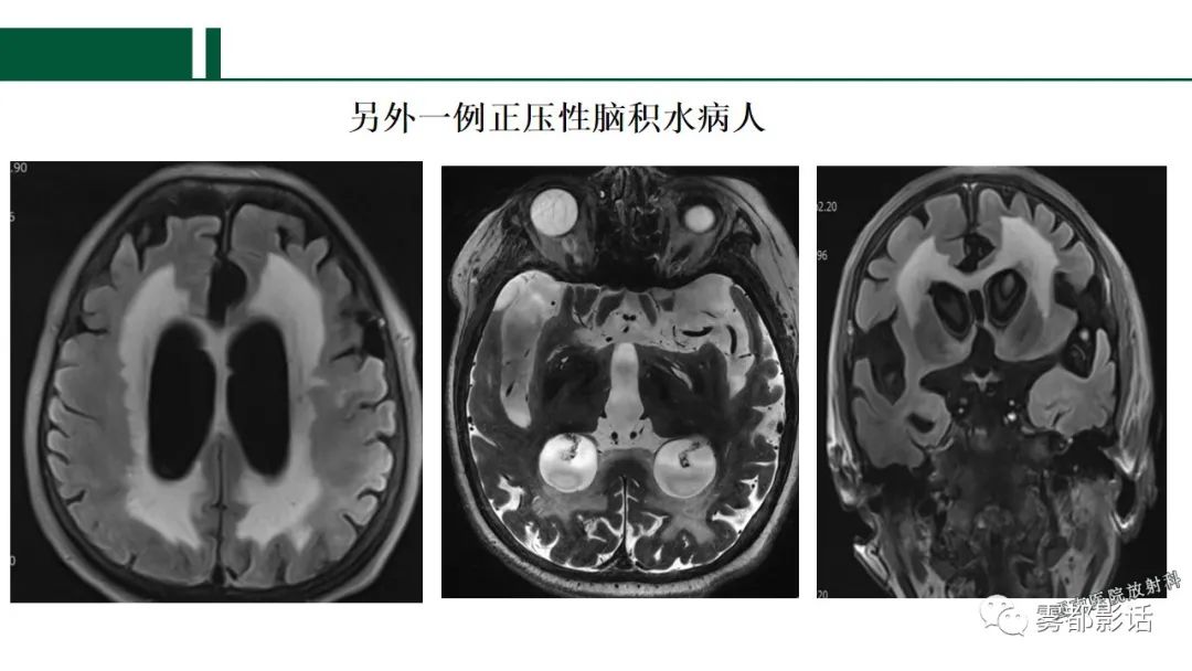 影像PPT - 【PPT】特发性正常压力脑积水的影像诊断-20