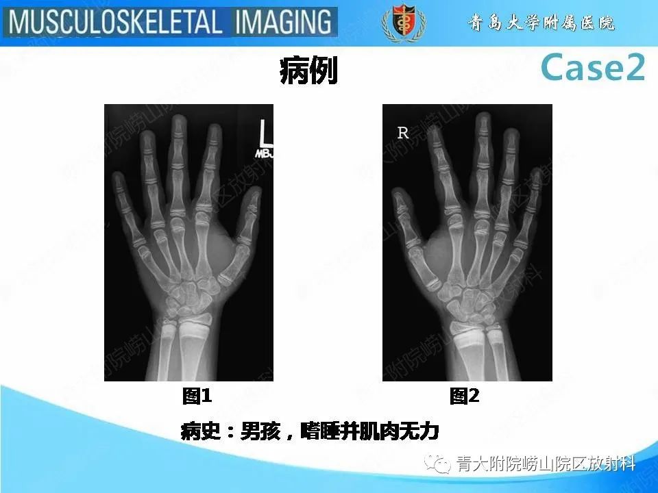 影像PPT - 【PPT】干骺端致密带-2