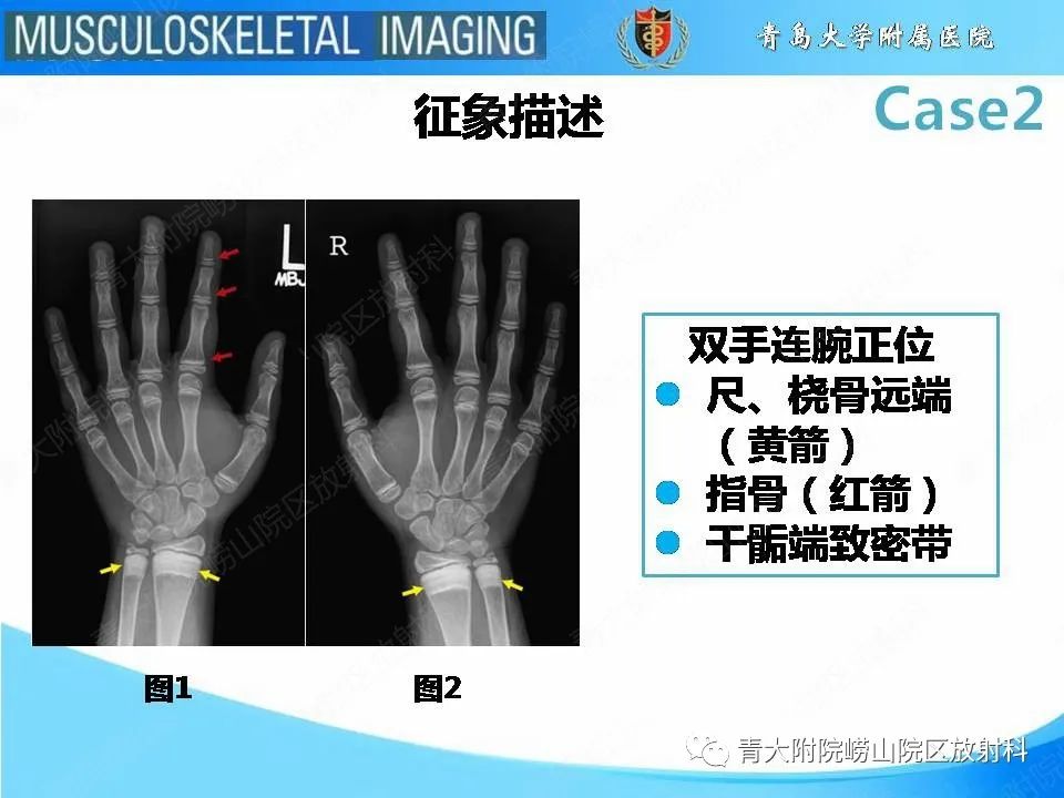 影像PPT - 【PPT】干骺端致密带-11