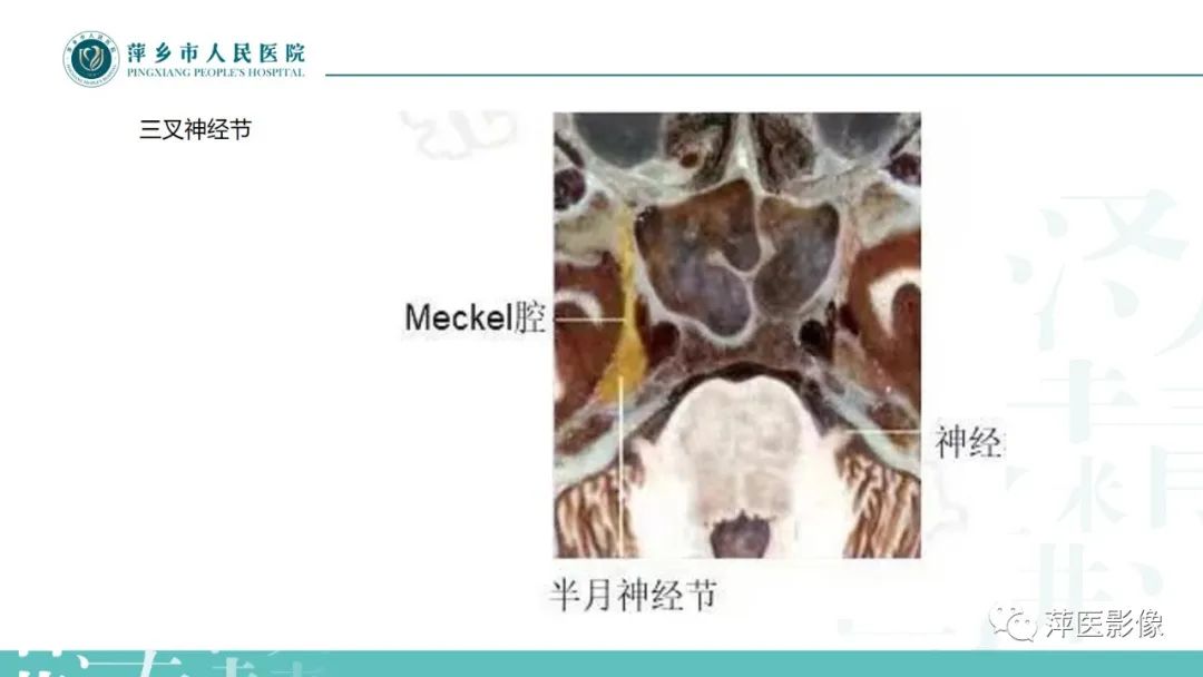 影像PPT - 【PPT】三叉神经痛-5