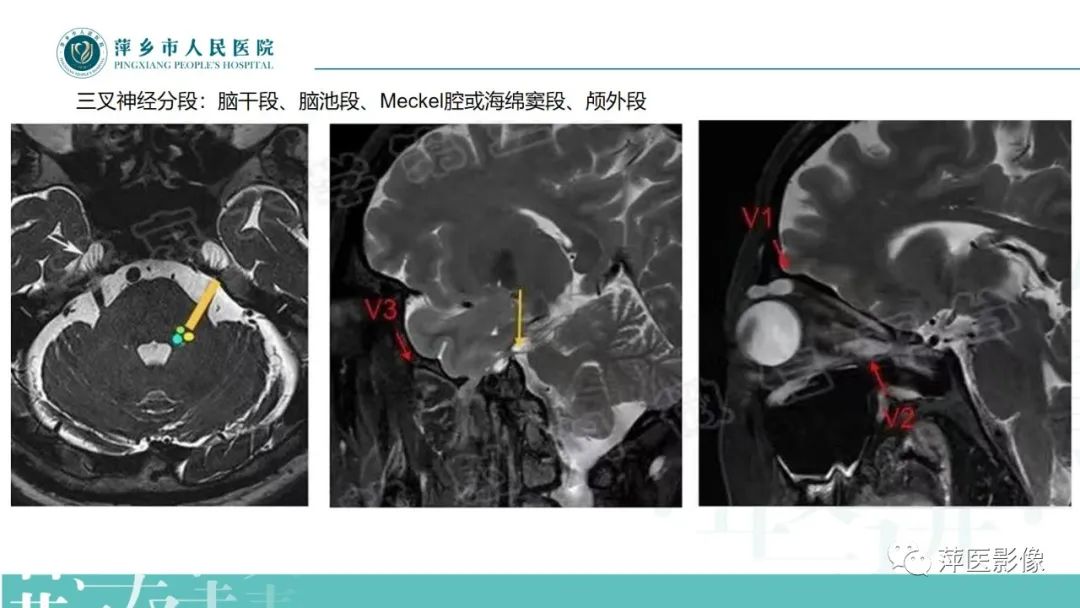 影像PPT - 【PPT】三叉神经痛-6