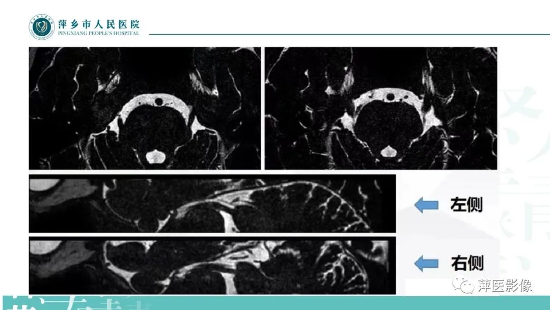 影像PPT - 【PPT】三叉神经痛-15