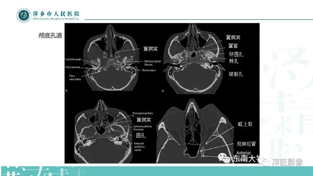 影像PPT - 【PPT】三叉神经痛-16