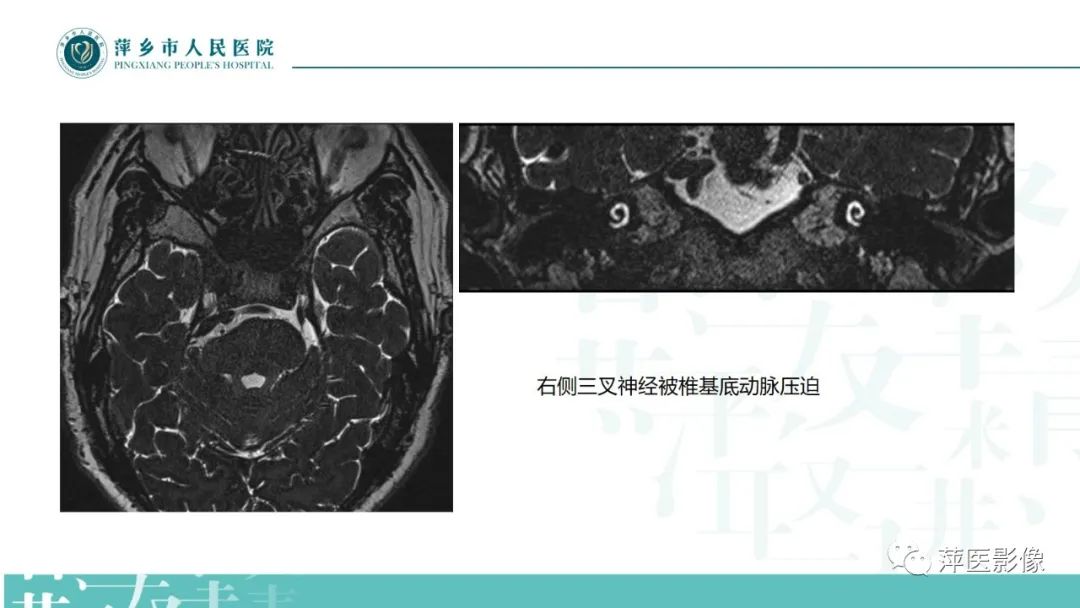 影像PPT - 【PPT】三叉神经痛-17