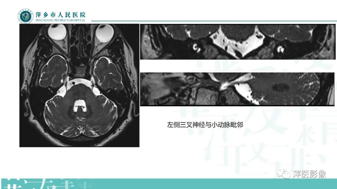 影像PPT - 【PPT】三叉神经痛-18