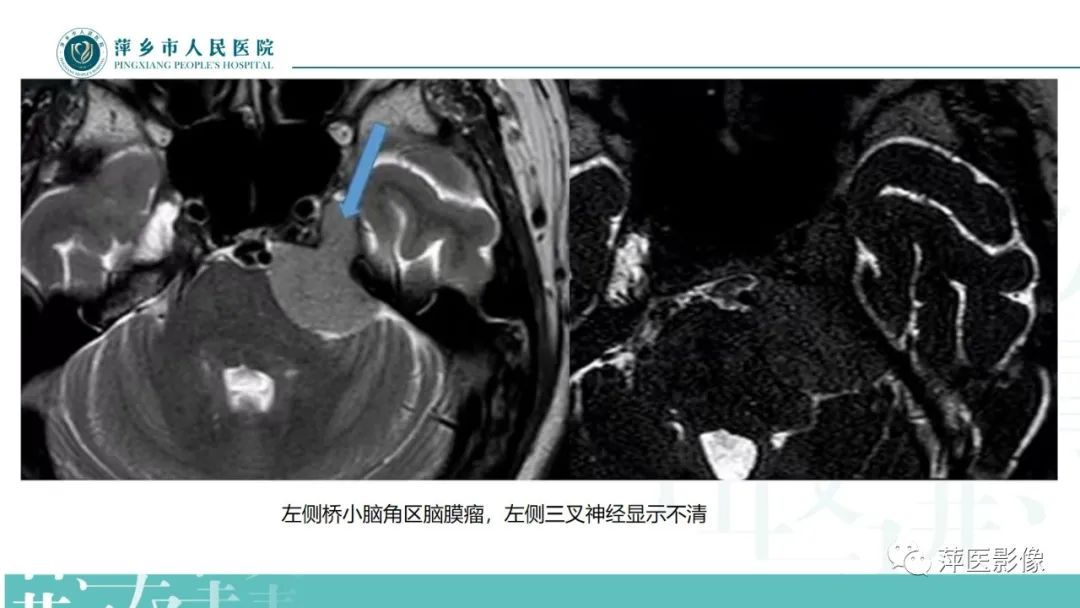 影像PPT - 【PPT】三叉神经痛-20