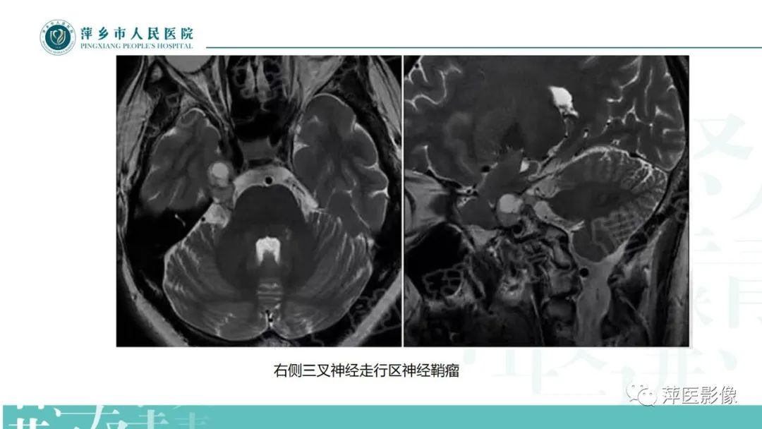 影像PPT - 【PPT】三叉神经痛-21